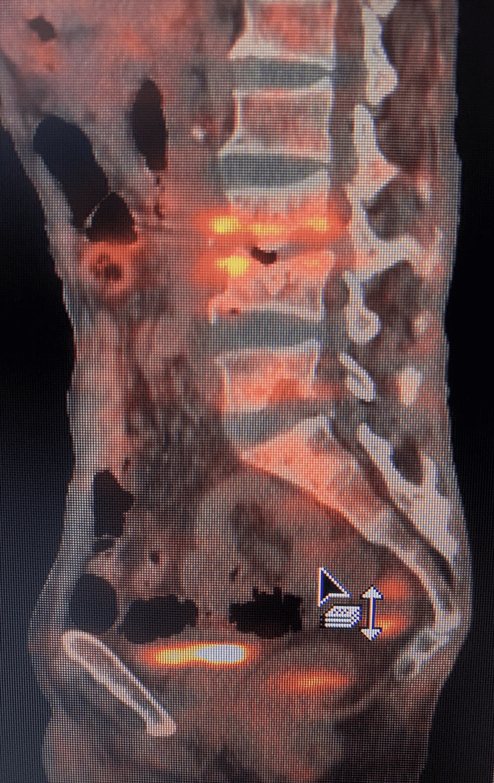 FDG-PET/CT-of-the-spine
