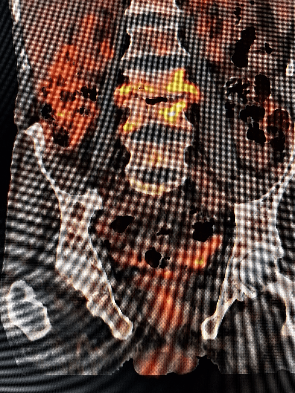 FDG-PET/CT-of-the-same-patient-as-above-after-six-months-showing-a-decrease-in-FDG-uptake-in-L3---L4-intervertebral-disc-(SUVmax-=-4.1)