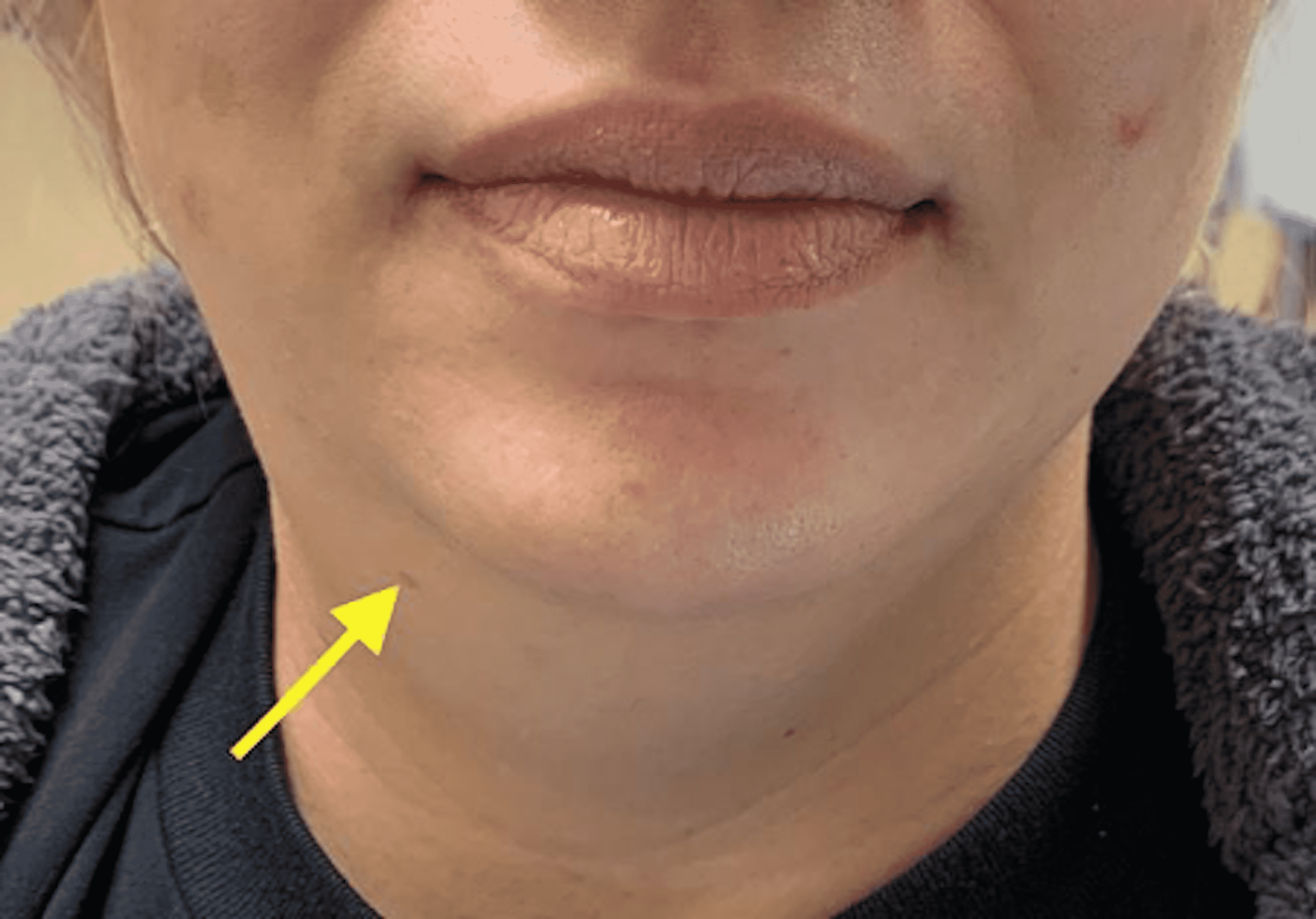 Acute Submandibular Sialadenitis As A Cause Of Unilateral Neck Swelling 