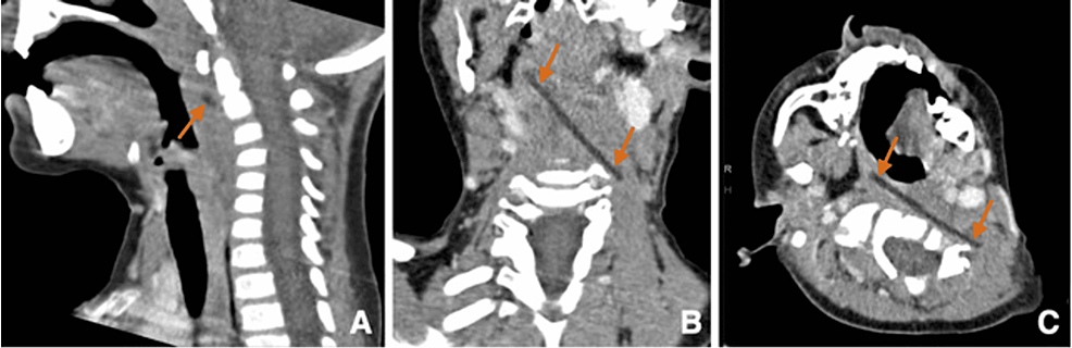 Sagittal-(A),-coronal-oblique-(B),-and-axial-oblique-(C)-reconstructions-of-contrast-enhanced-CT-scan-illustrating-a-5.8-cm-long,-linear-hypodensity-located-in-the-prevertebral-soft-tissues,-along-with-an-inversion-of-the-cervical-spine-lordosis.