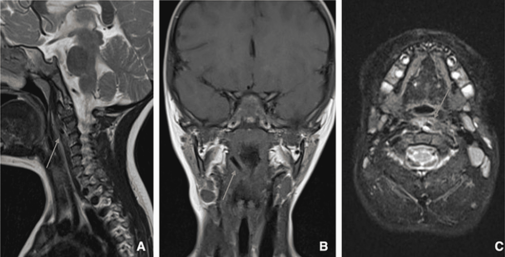 Sagittal-T2-weighted-(A),-coronal-T1-weighted-(B)-and-axial-T2-weighted-with-fat-saturation-(C)-planes-of-the-head-and-neck-MRI.