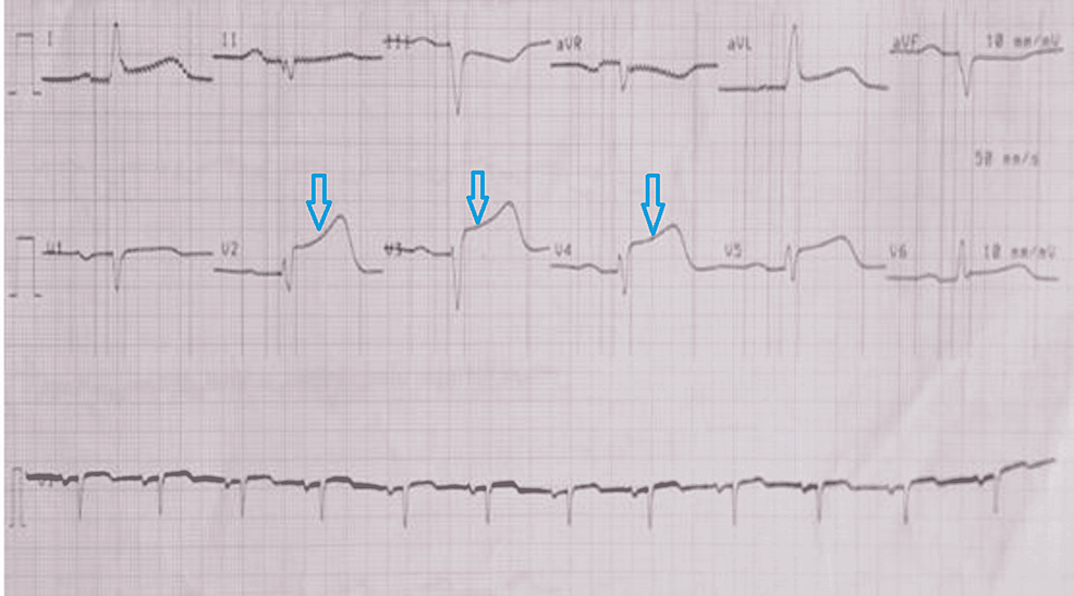 Electrocardiogram-showing-ST-elevation-in-leads-V2-V5