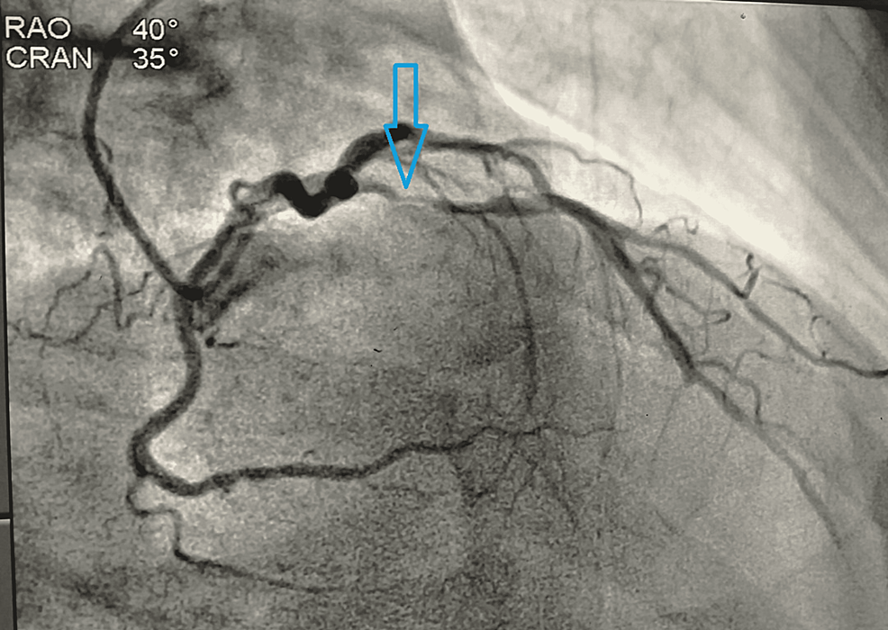 Coronary-angiogram-in-RAO-view-showing-stenosis-(90-95%)-of-LAD-artery--