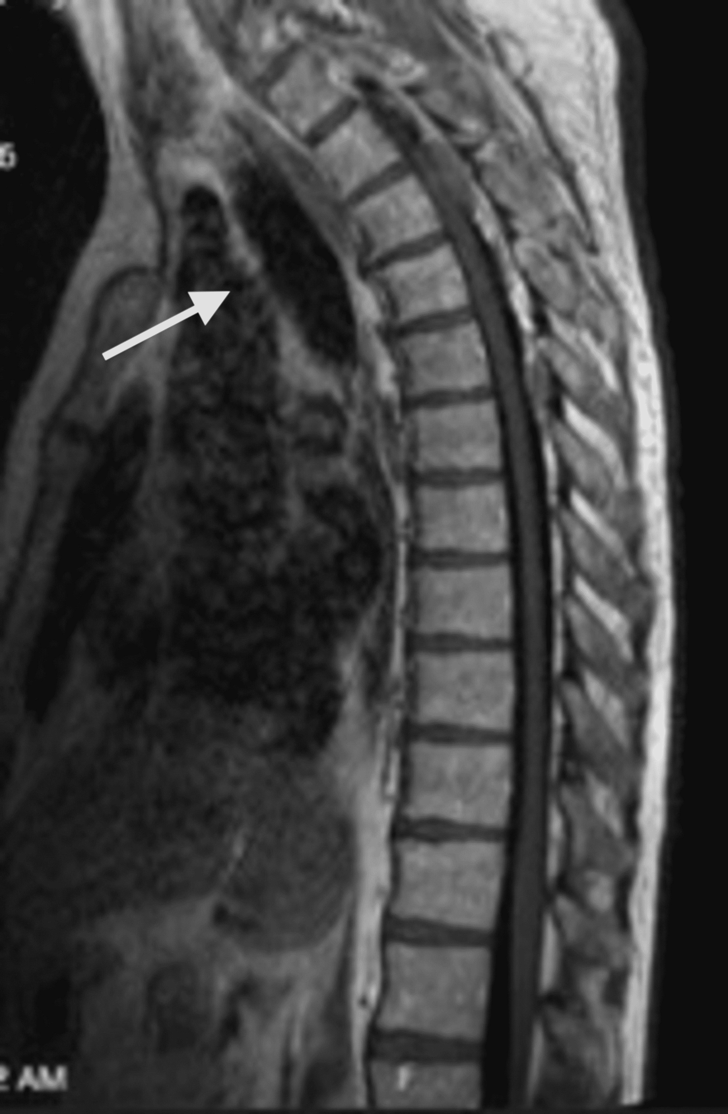 Cureus Sinking Skin Flap Syndrome After Decompressive Hemicraniectomy In A Patient With Calvarial Multiple Myeloma Who Underwent A Lumbar Puncture A Case Report