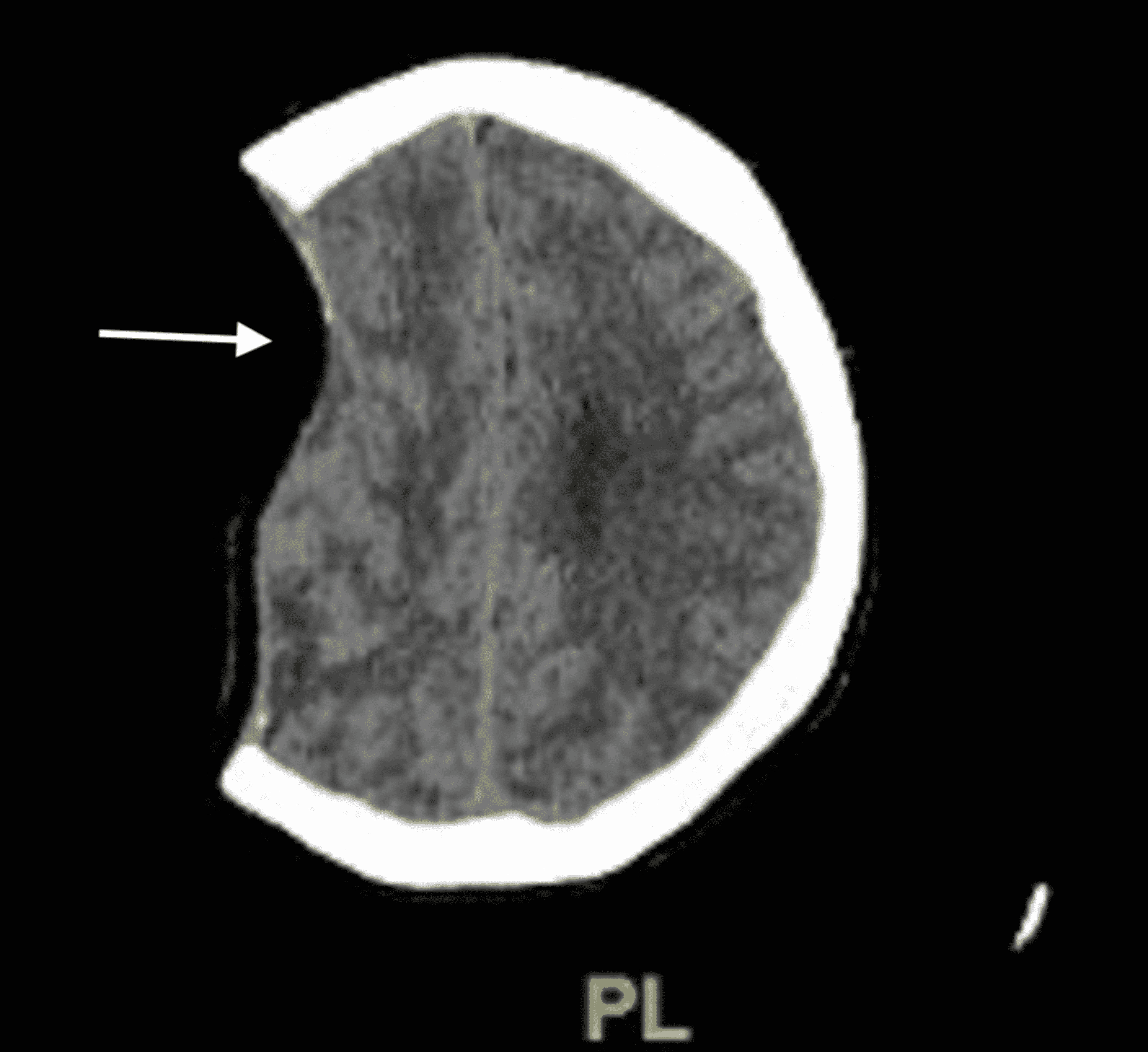 Cureus Sinking Skin Flap Syndrome After Decompressive Hemicraniectomy In A Patient With Calvarial Multiple Myeloma Who Underwent A Lumbar Puncture A Case Report