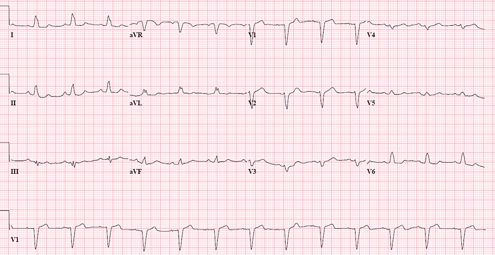 Cureus | Left Atrial Myxoma Presenting as Persistent Dizziness