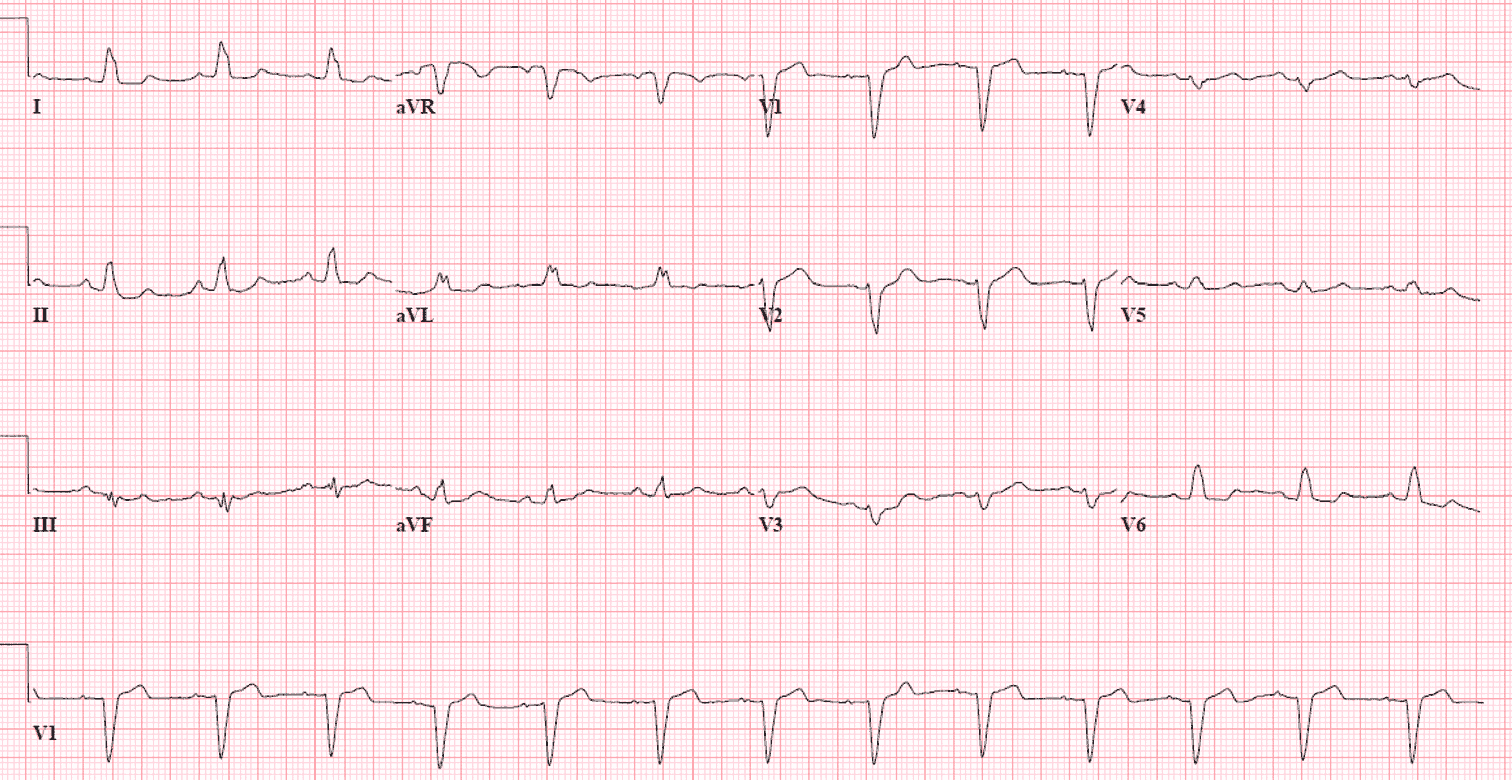 Cureus | Left Atrial Myxoma Presenting as Persistent Dizziness