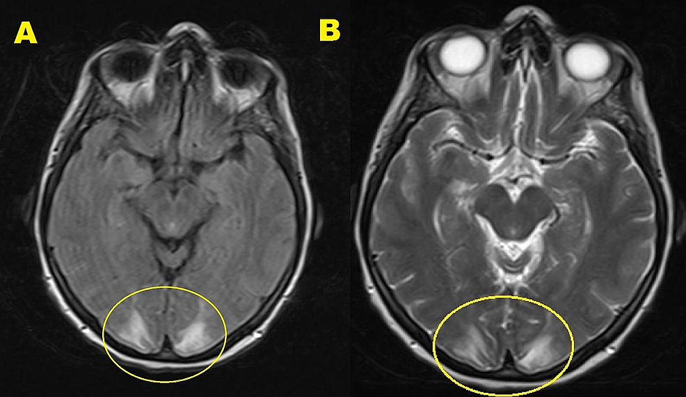 Trastuzumab-associated Posterior Reversible Encephalopathy Syndrome ...