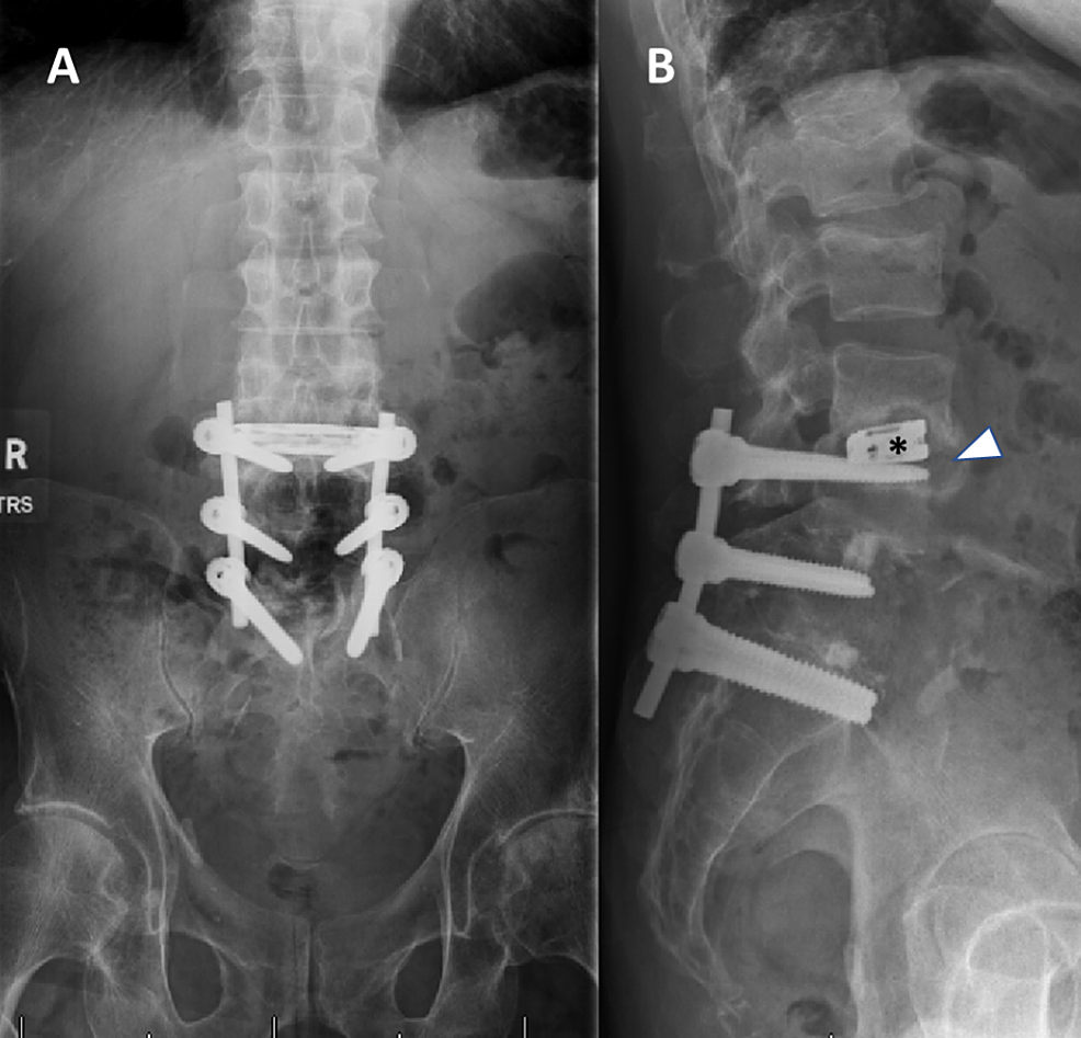 Cureus Extreme Lateral Interbody Fusion Complicated by