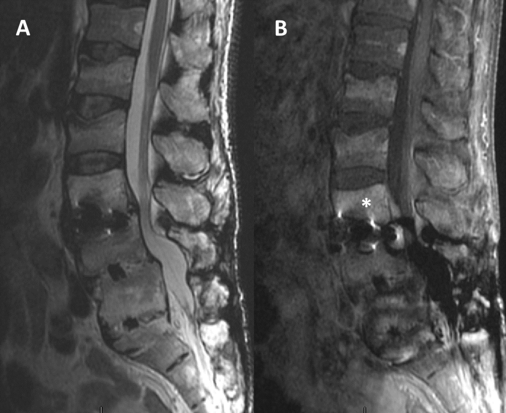 Cureus | Extreme Lateral Interbody Fusion Complicated By Fungal ...