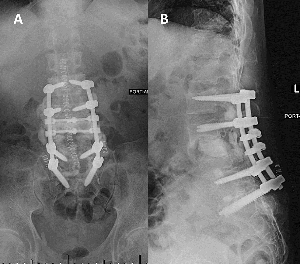 Cureus | Extreme Lateral Interbody Fusion Complicated by Fungal ...