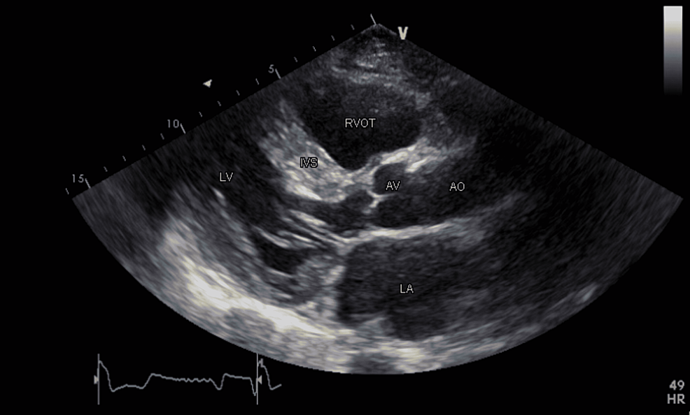 Persistent Atrium Standstill Post Atrial Fibrillation Ablation Therapy ...