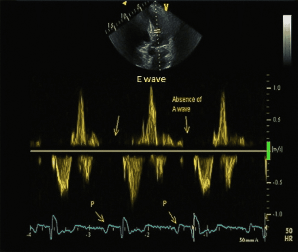 Cureus Persistent Atrium Standstill Post Atrial Fibrillation Ablation