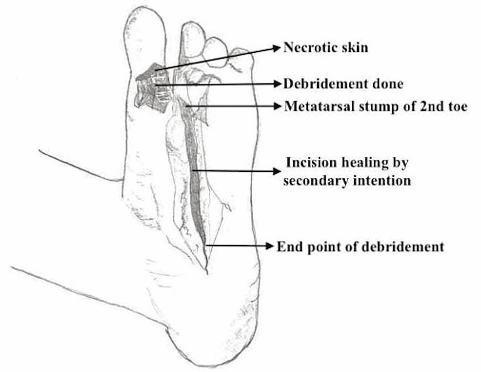 Labeled-illustration-of-post-operative-foot-of-the-patient.