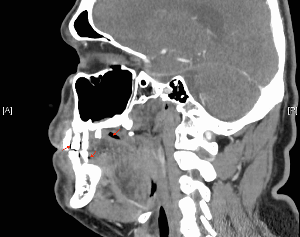 Bilateral Maxillary and Mandibular Periapical Abscesses - Cureus