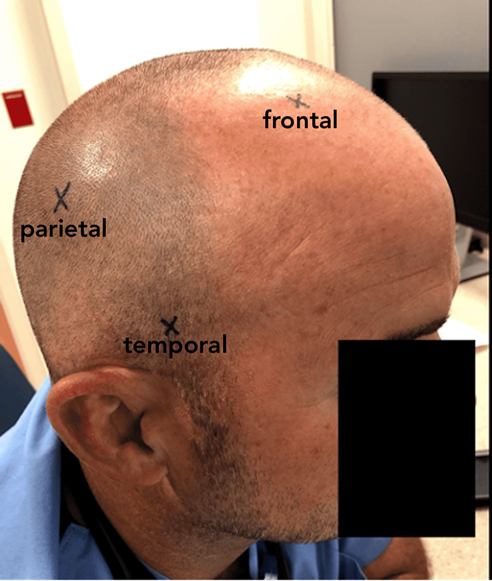 Cureus Emergency Craniostomy “Burr Hole” Using an