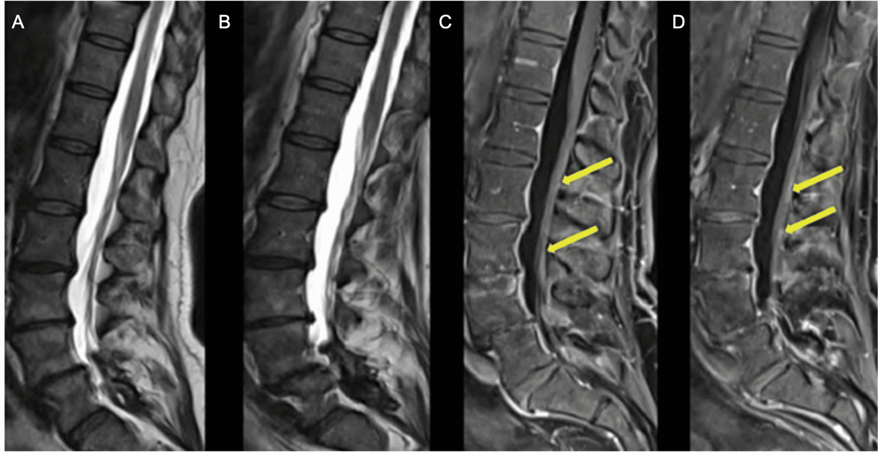 Cureus | Neurologic Sequela of COVID-19: Guillain-Barré Syndrome ...