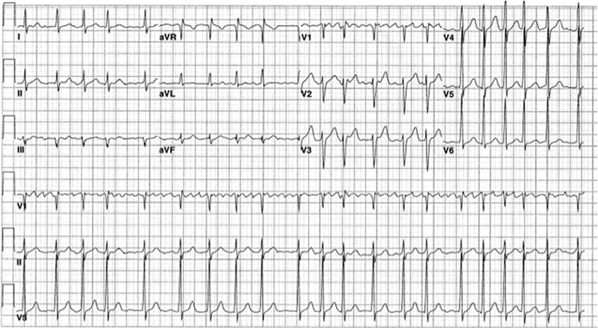 Cureus | Cyclophosphamide-induced Atrial Fibrillation With Rapid ...