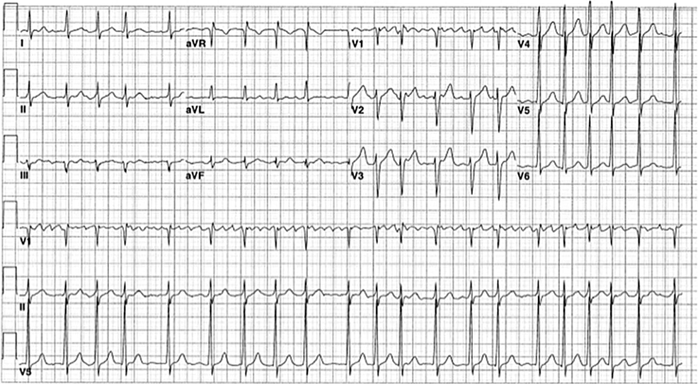 Cureus | Cyclophosphamide-induced Atrial Fibrillation With Rapid ...