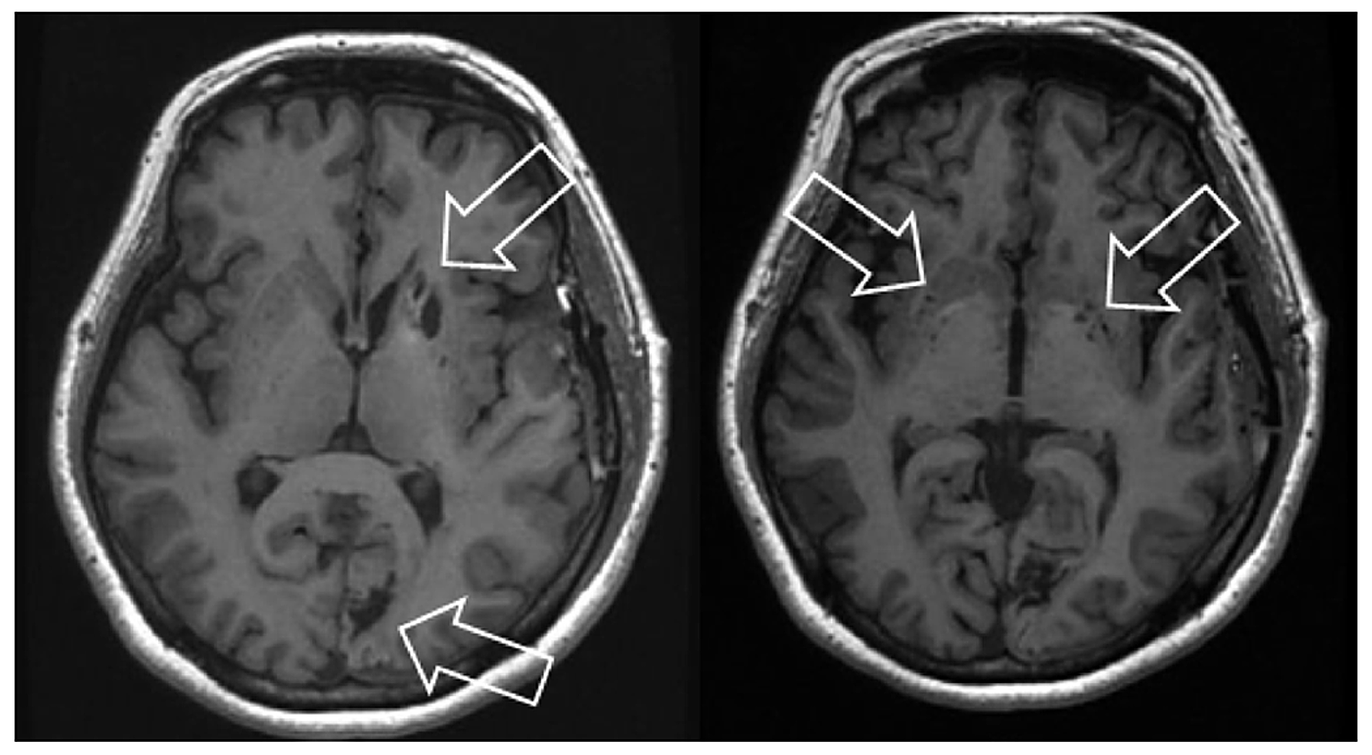 Cureus | Moyamoya Disease: Current Concepts