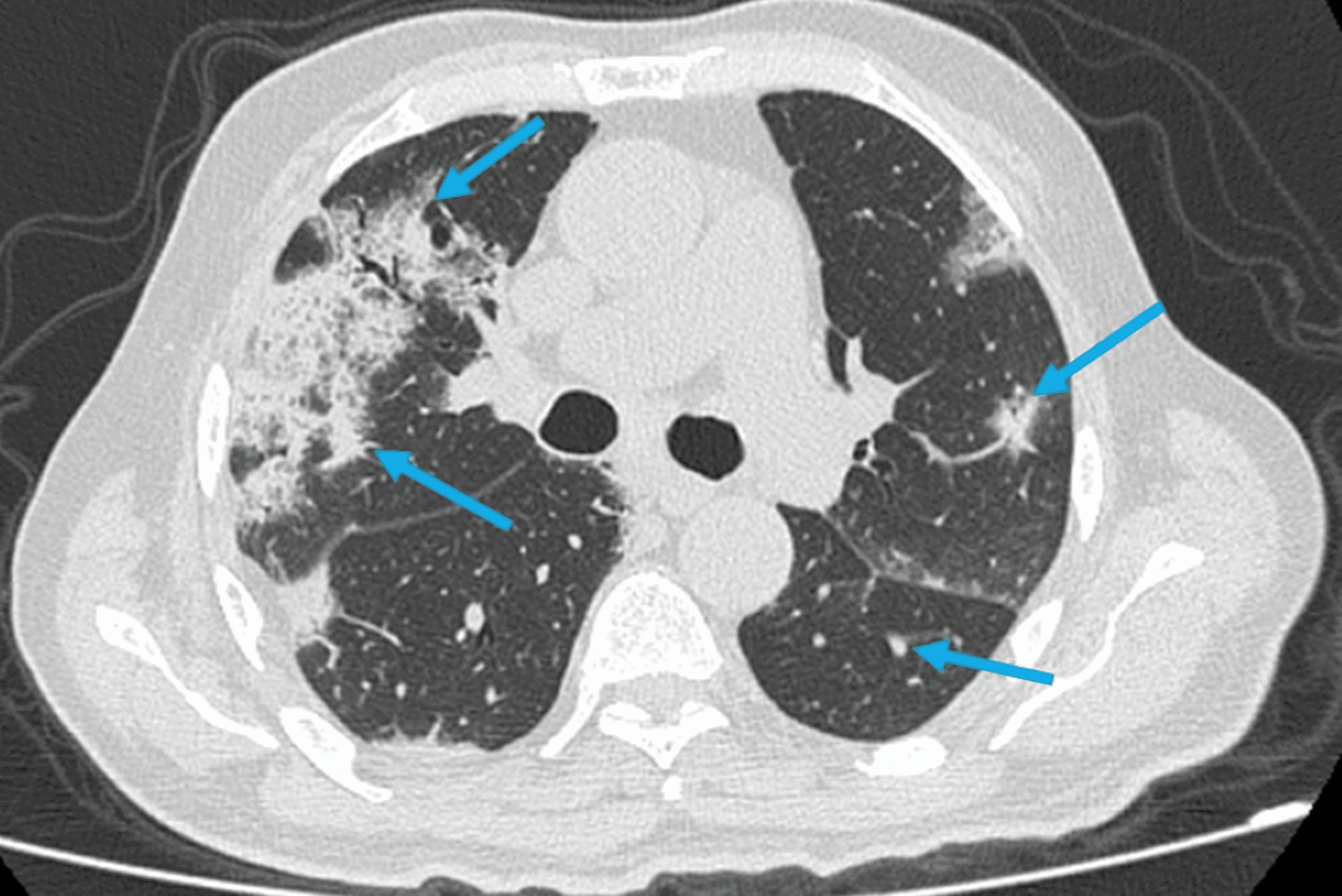 Cureus | Acute Pancreatitis: An Unusual Extrapulmonary Manifestation Of ...