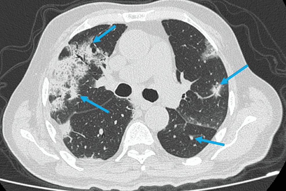 CT-chest-showing-isolated-infiltrates-and-consolidation-in-both-lungs.