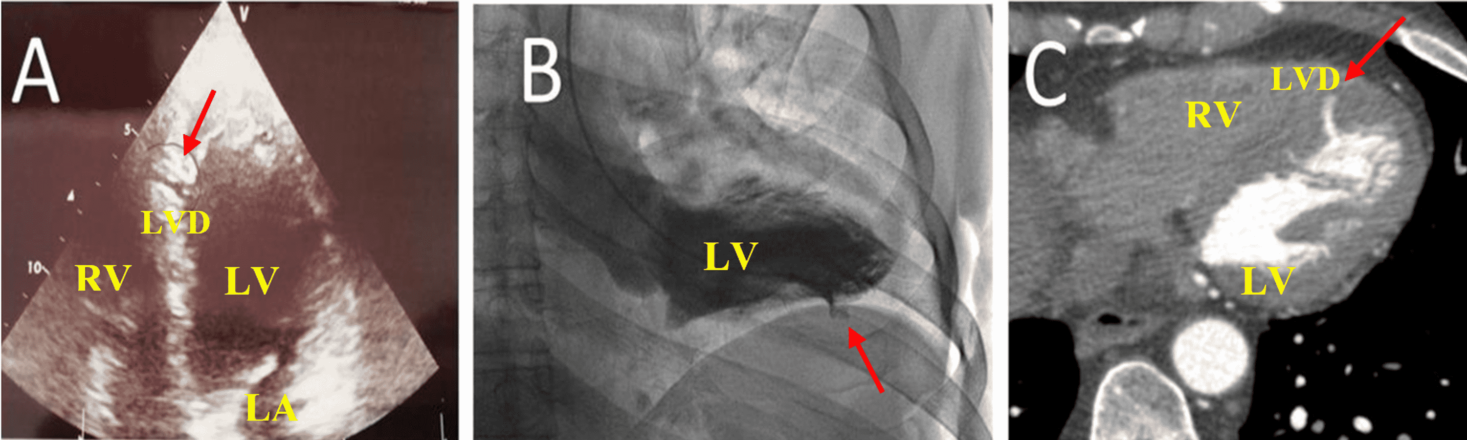 Cureus | Left Ventricular Diverticulum Mimicking Ventricular Septal ...