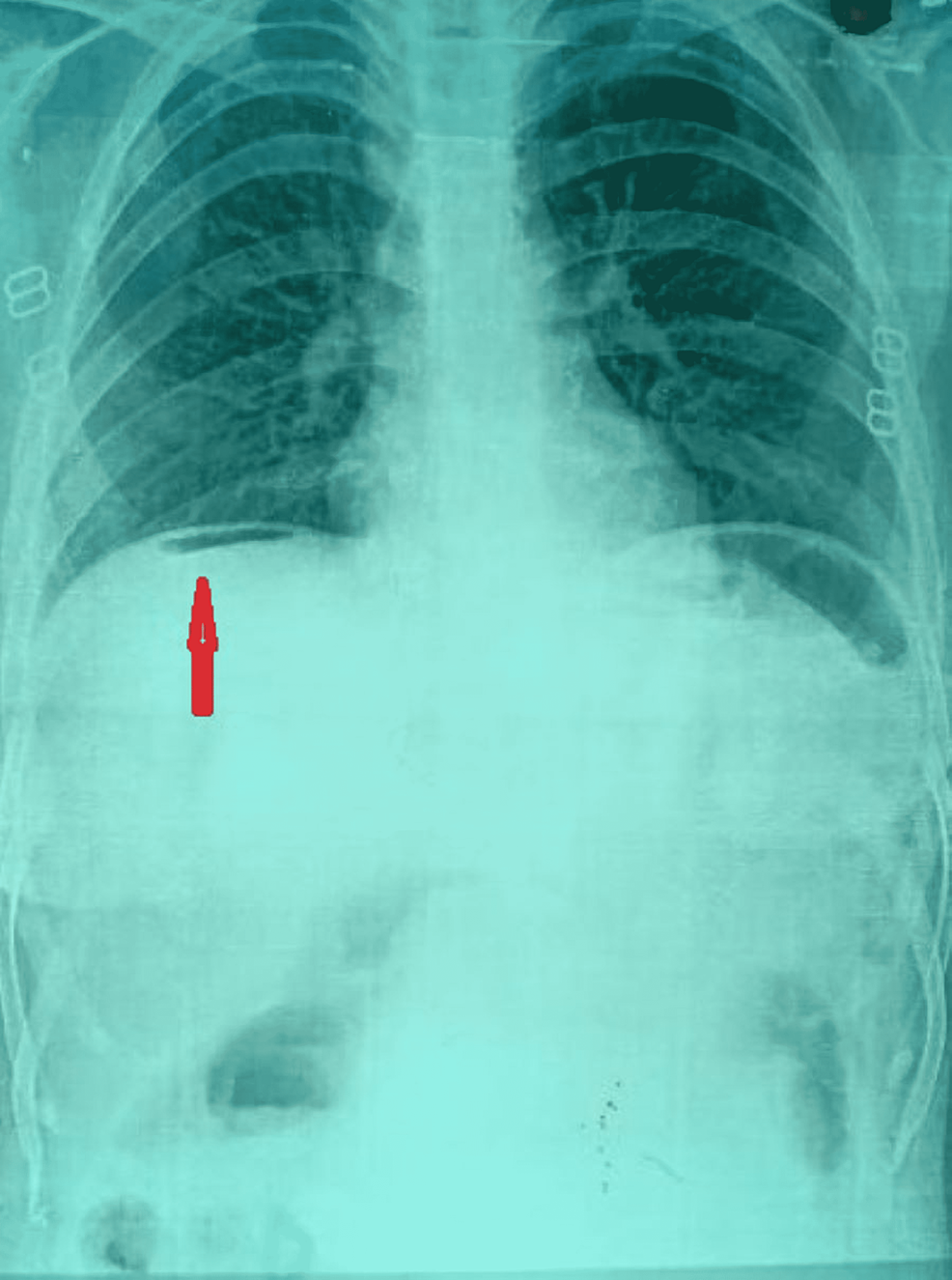 cureus-gastric-perforation-with-peritonitis-secondary-to-a