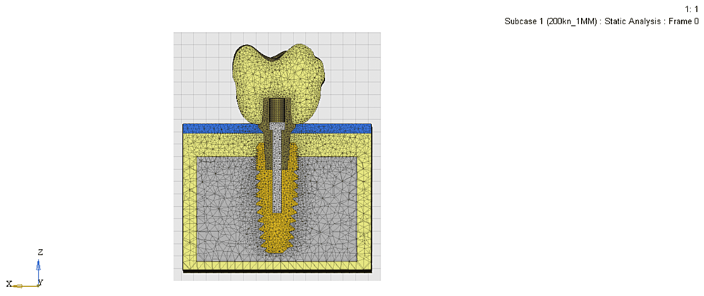 Mesh-model-of-the-1-mm-sub-crestally-placed-implant
