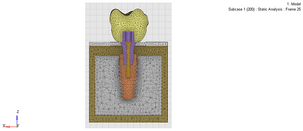 Mesh-model-of-the-2-mm-sub-crestally-placed-implant