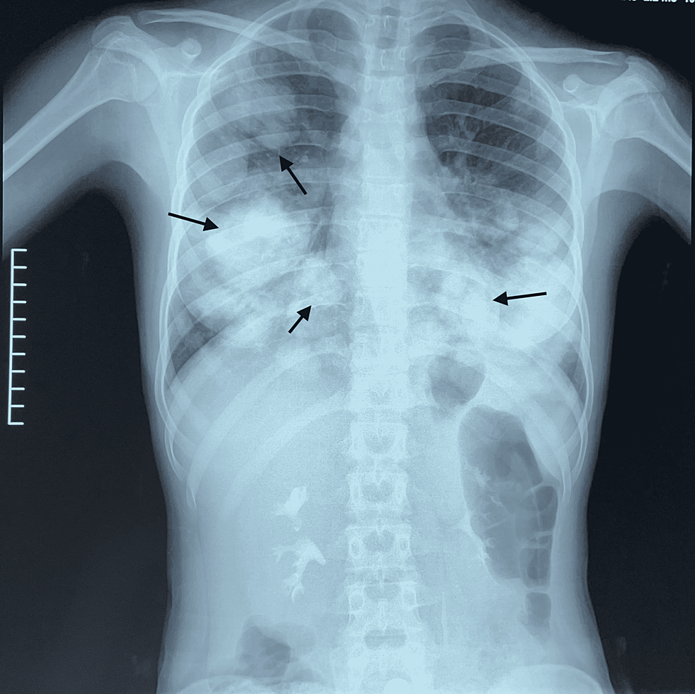 Cureus What Lies Behind the Cannonball Pulmonary Metastases Hodgkin