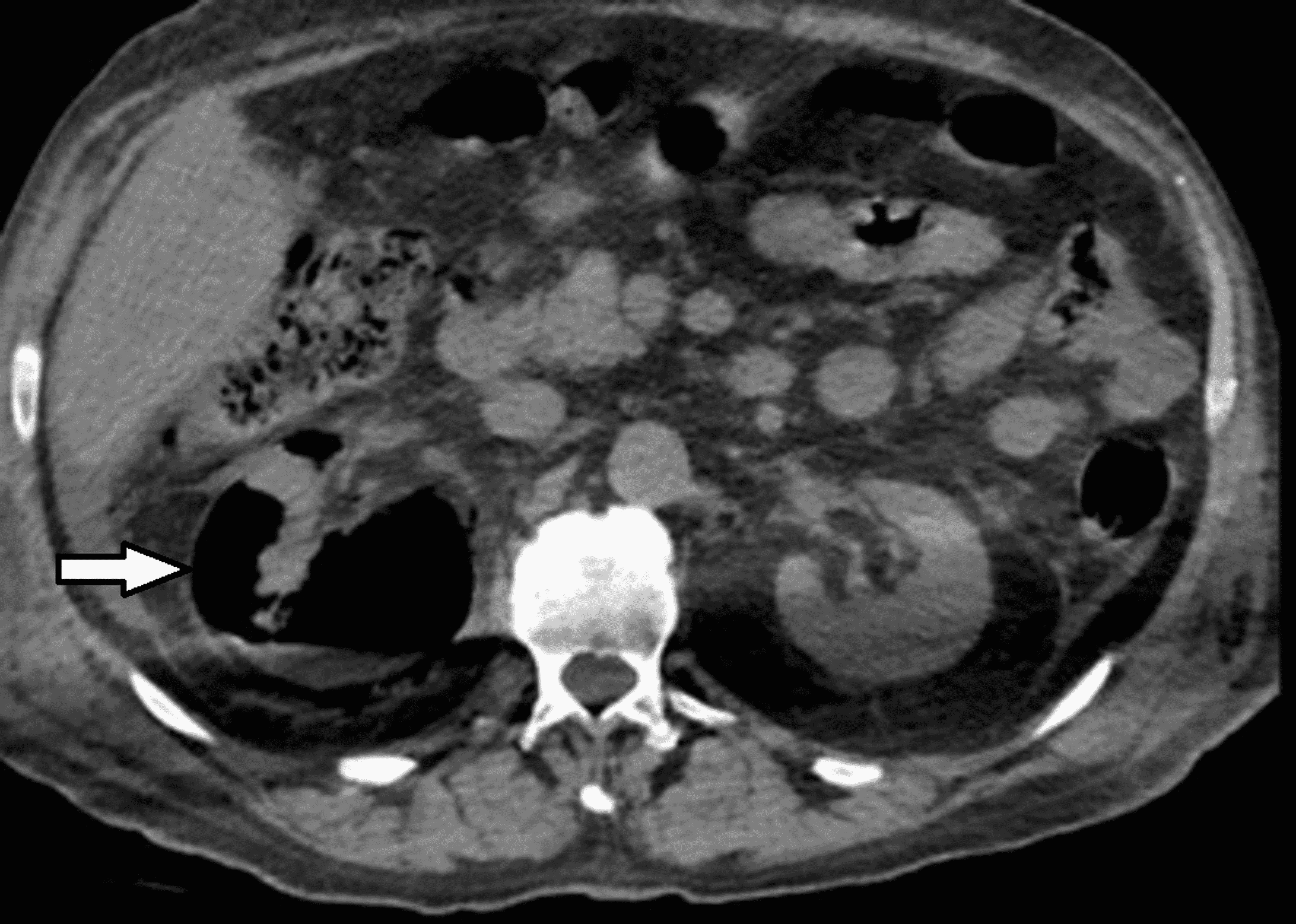 Cureus Emphysematous Pyelonephritis Complicated With Hyperglycemic