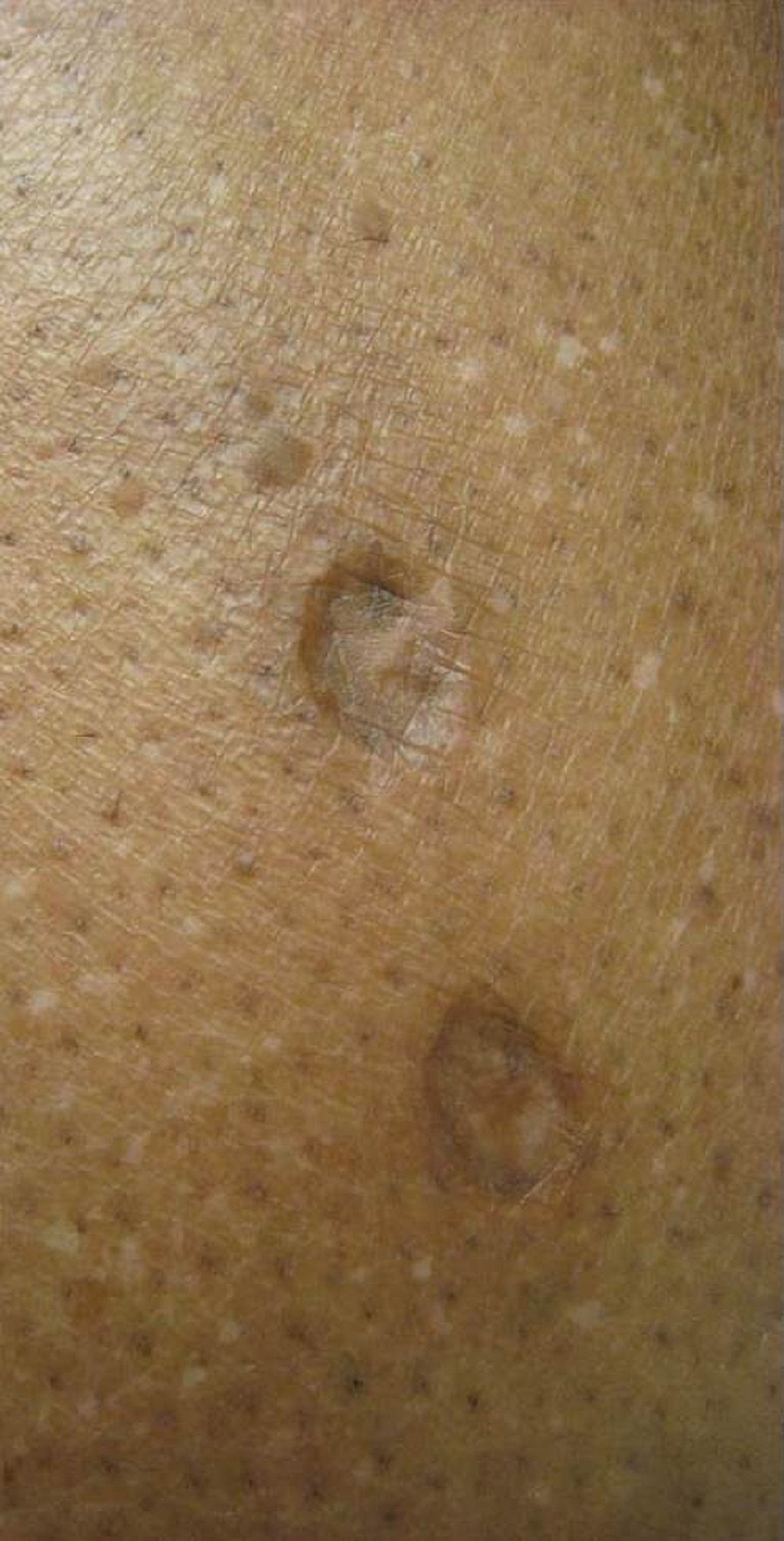 A-close-up-view-of-the-skin-popping-scars-with-atrophic,-hyperpigmented-papules