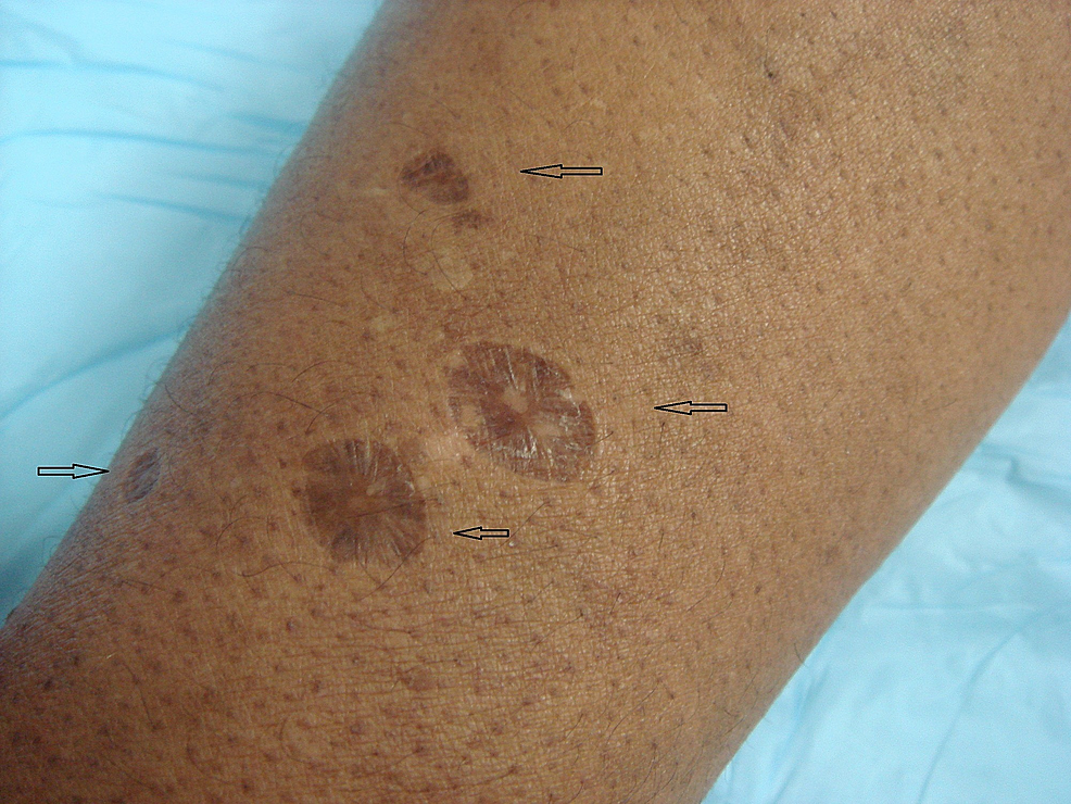Forearm-with-round,-depressed,-hyperpigmented-papules-and-plaques-(arrows)
