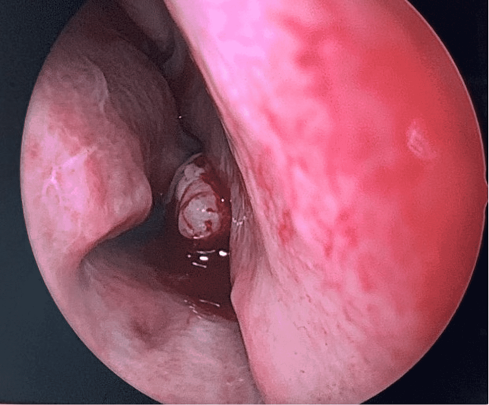 Endoscopic-examination-of-the-nose-showing-the-body-on-the-floor-of-the-right-nasal-cavity.
