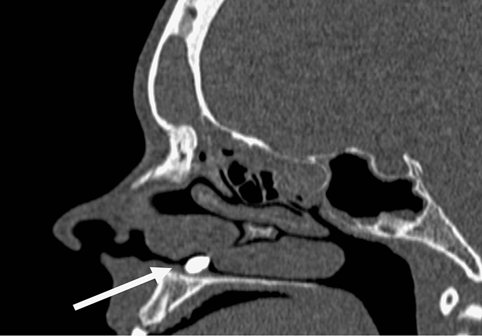 Preoperative-sagittal-computed-tomography-imaging-of-the-paranasal-sinuses-showing-an-intranasal-tooth-(white-arrow).