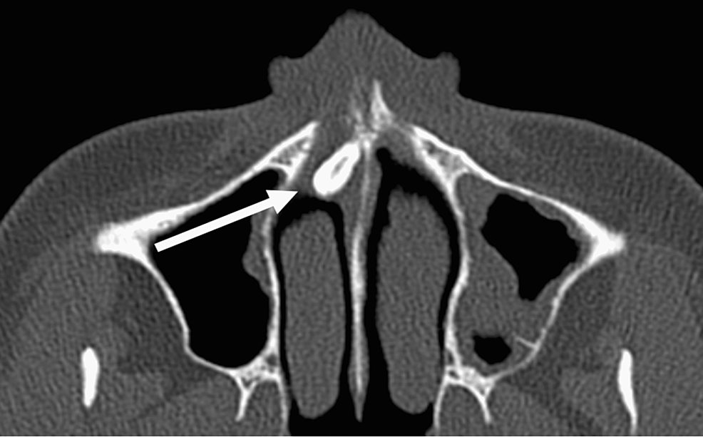 Preoperative-axial-computed-tomography-imaging-of-the-paranasal-sinuses-showing-an-intranasal-tooth-(white-arrow).-