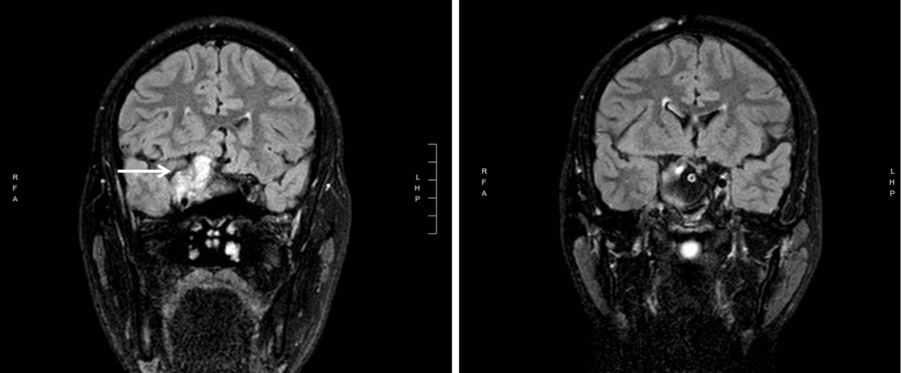 Cureus Unilateral Compressive Optic Neuropathy As The Presenting Manifestation Of Clival 6696