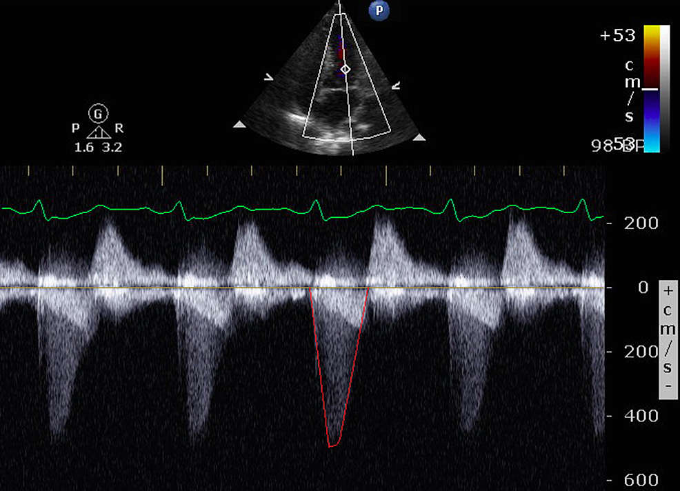 cureus-the-disappearing-murmur-systolic-anterior-motion-of-the