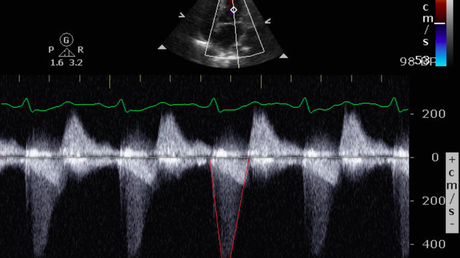 Cureus | The Effervescent Gallbladder: An Emergency Medicine Bedside ...