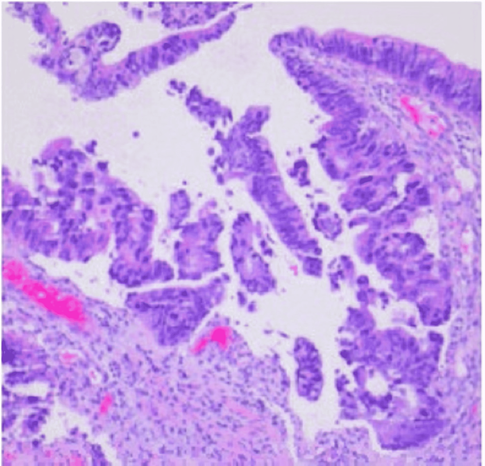 Rectal-mass-biopsy-showing-superficial-mucosal-tissue-lined-by-highly-atypical-dysplastic/neoplastic-glandular-epithelial-cells-with-nuclear-pleomorphism,-prominent-nucleoli,-and-frequent-mitotic-figures.-This-is-consistent-with-at-least-intramucosal-adenocarcinoma.-Invasive-growth-cannot-be-excluded.