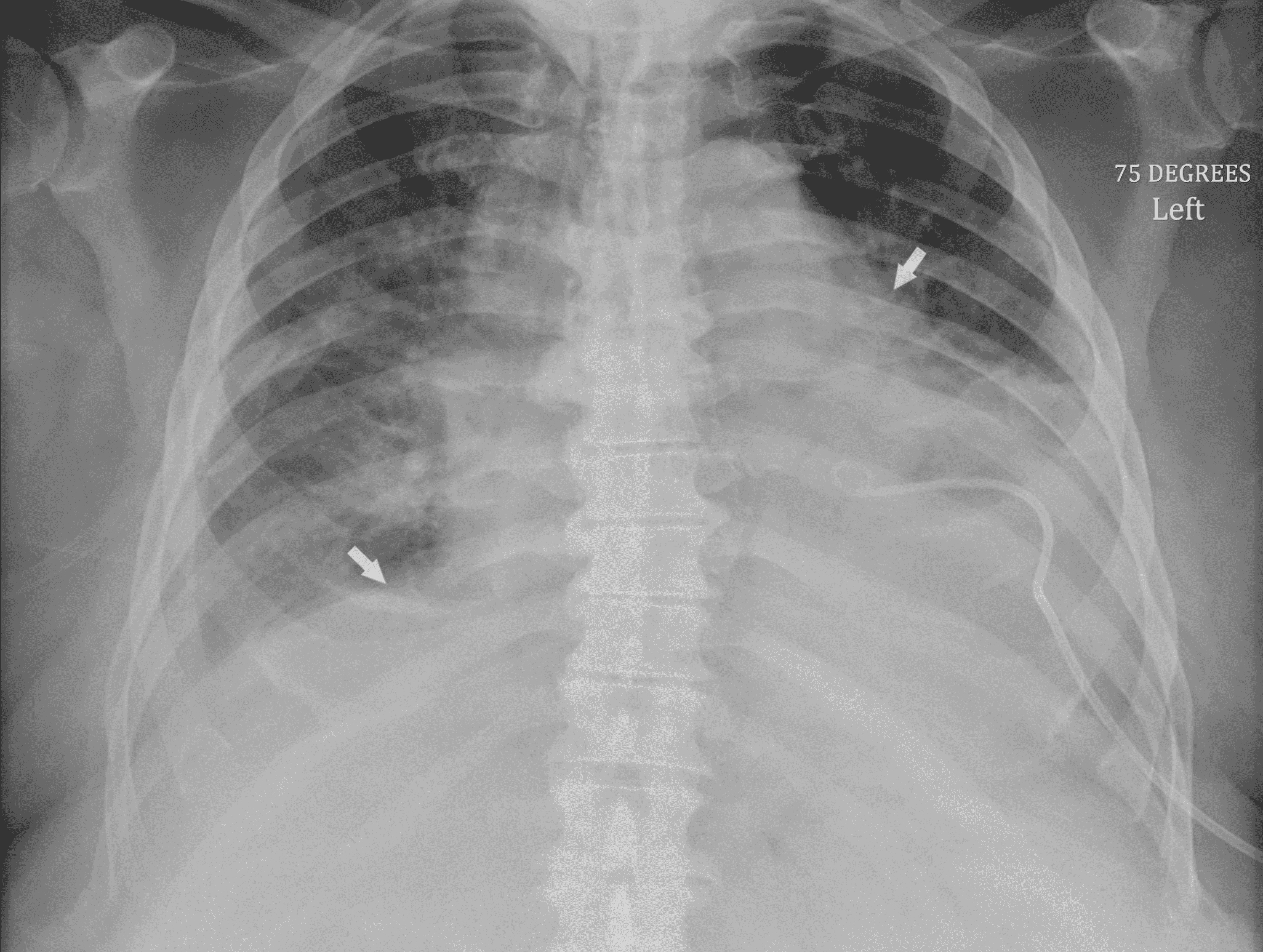 Cureus Spontaneous Tumor Lysis Syndrome in a Patient With a Known