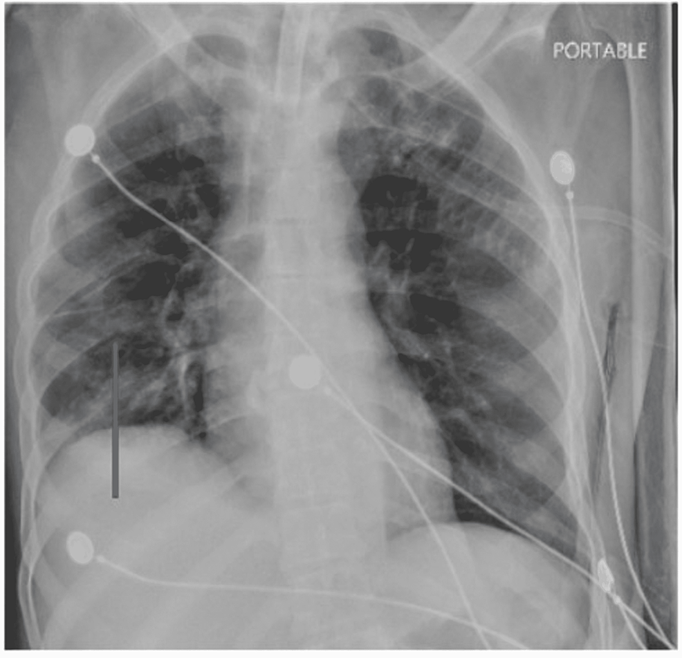 Chest-X-ray-showing-patchy-bilateral-airspace-disease,-greatest-in-the-right-mid-to-lower-lung.-Taken-during-current-patient-admission.