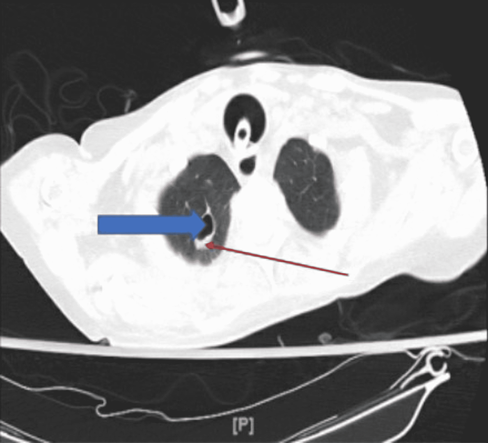 CT-showing-a-thin-walled-cavitary-lesion-in-the-apical-segment-of-the-right-upper-lobe.-The-red-arrow-is-pointing-to-the-thin-walls-of-the-cavitation,-and-the-blue-arrow-is-pointing-to-the-cavitation-as-a-whole.
