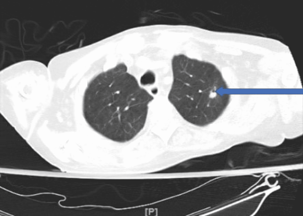 CT-showing-cavitary-lesion-in-the-apical-posterior-segment-of-the-left-upper-lobe-(blue-arrow)-taken-during-patient-admission.
