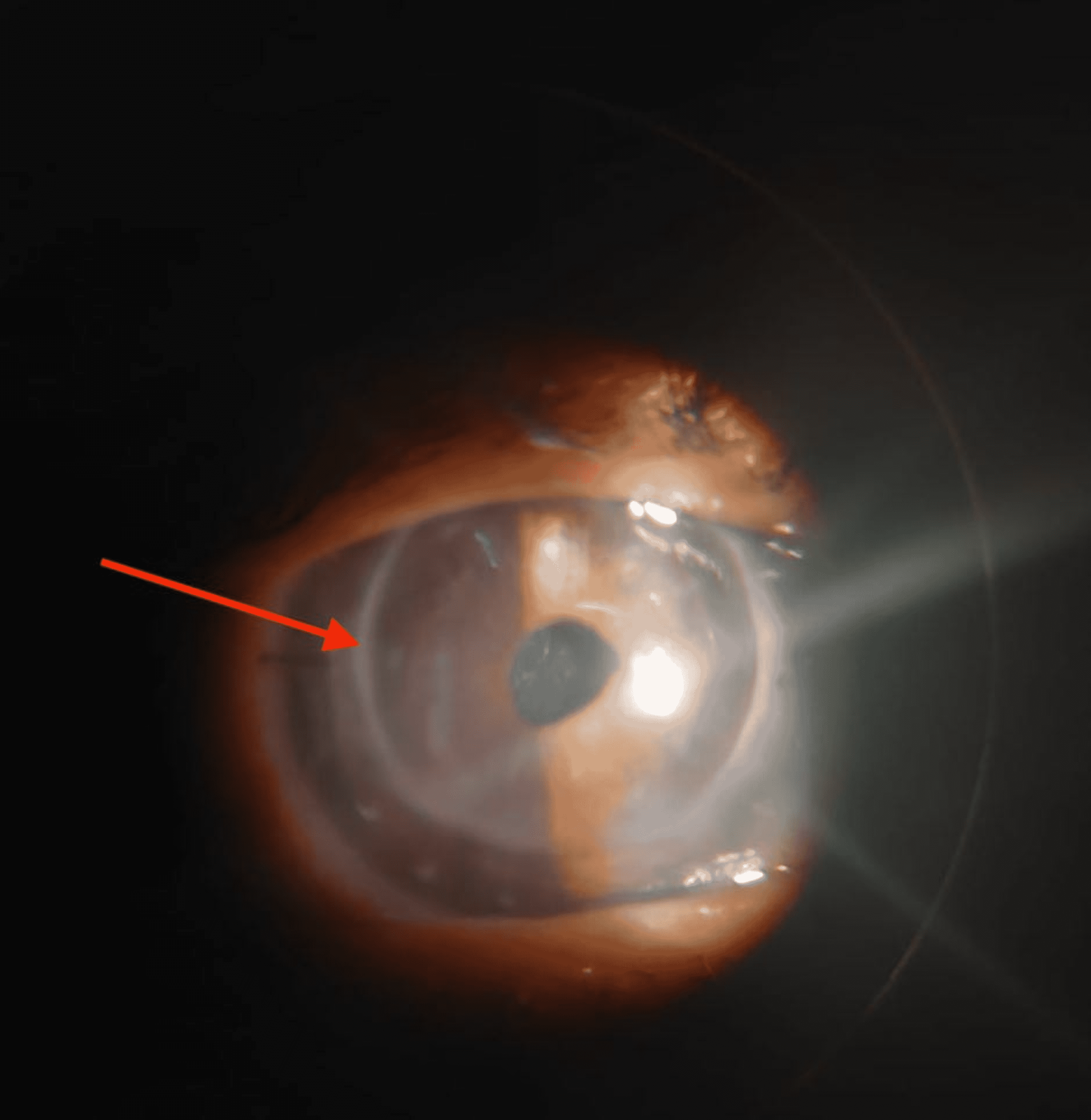 Cureus Complete Occlusion of Anterior Capsular Opening in Patient Operated for Cataract With