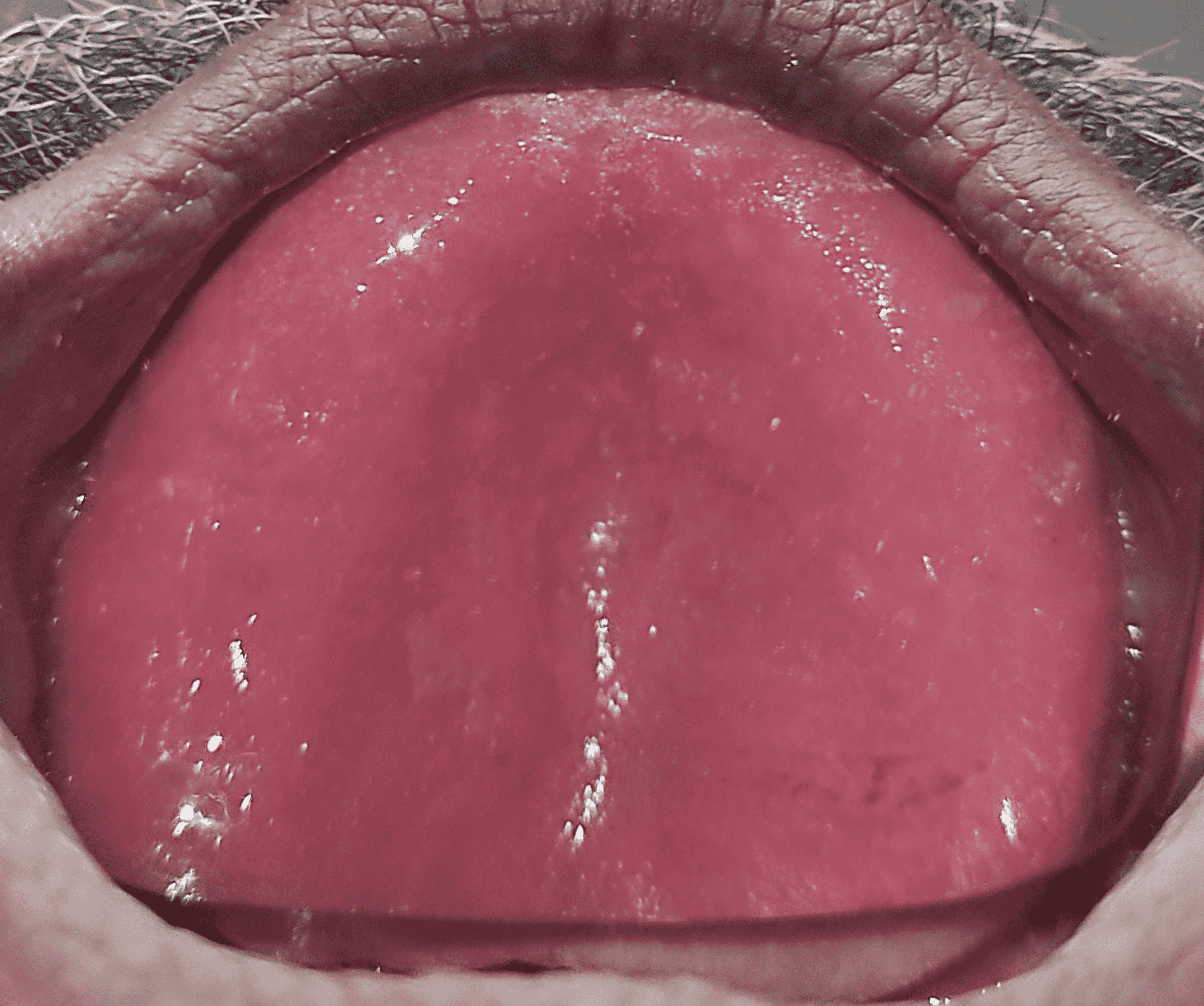 Cureus A Simple StepbyStep Technique for the Management of Gagging