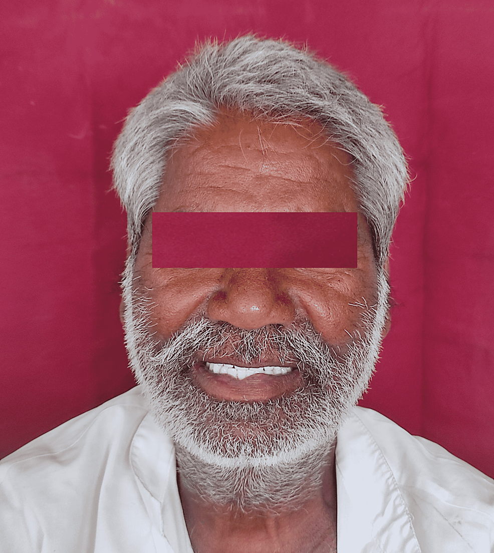 Cureus A Simple StepbyStep Technique for the Management of Gagging