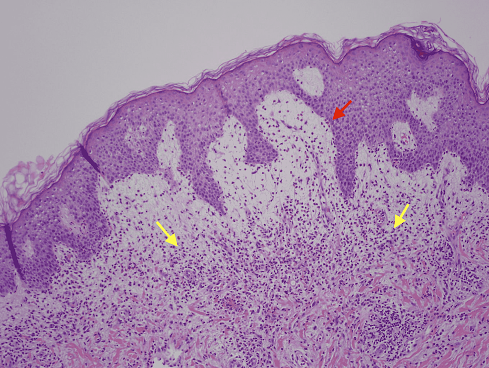 H&amp;E-stain-showing-increased-eosinophils-and-sub-epidermal-vesicle-formation-at-100x-magnification.-Yellow-arrows-are-pointing-at-eosinophils—red-arrows-point-at-sub-epidermal-edema.