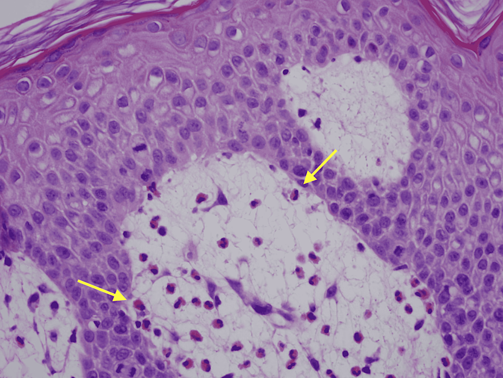 H&amp;E-stain-showing-increased-markedly-increased-eosinophils-at-400x-magnification.-Yellow-arrows-depict-eosinophils.